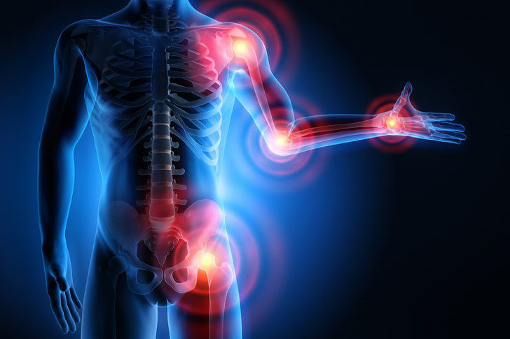 Artritis y tratamiento natural