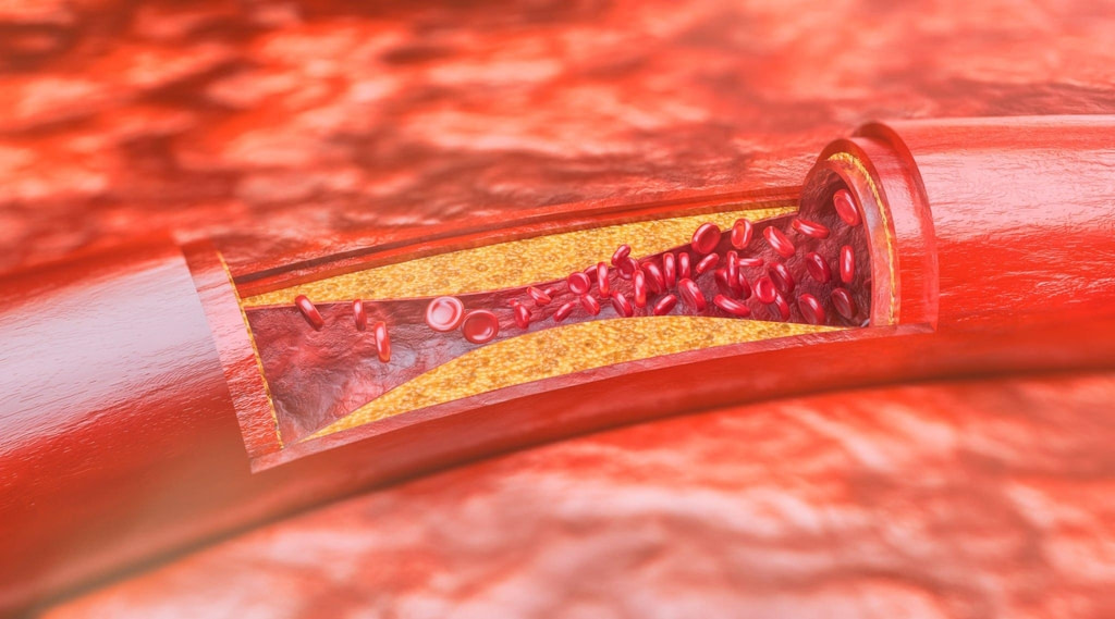 Qué es la Enfermedad Vascular Aterosclerótica