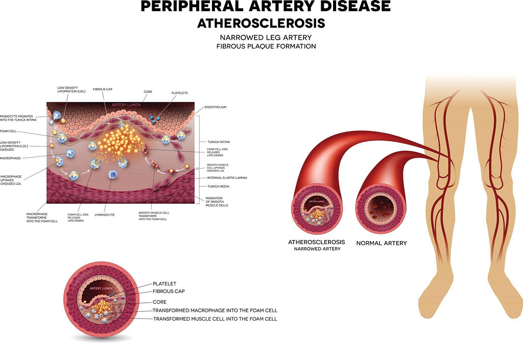 aterosclerosis y la Enfermedad Vascular Aterosclerótica