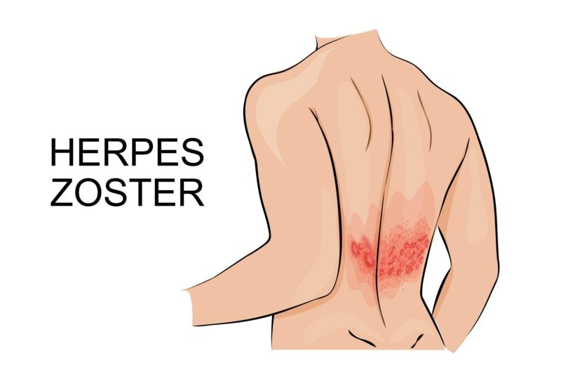 Herpes Zóster